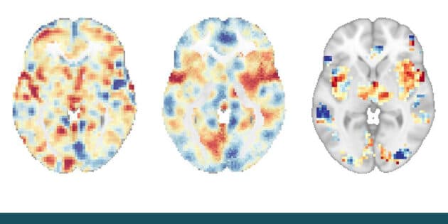 Gehirnscans zeigen unterschiedliche neuronale Signaturen, die mit der Schmerzreaktion verbunden sind: Das sog. NAPS (links) steht im Zusammenhang mit der emotionalen Schmerzerfahrung, das SIIPS-1 (mittig) bezieht sich auf unsere Schmerzerwartungen und andere psychosoziale Faktoren, und das NPS (rechts) ist mit der Schmerzintensität verknüpft. Copyright/Quelle: UC San Diego Health Sciences