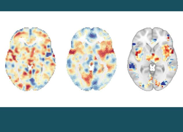 Gehirnscans zeigen unterschiedliche neuronale Signaturen, die mit der Schmerzreaktion verbunden sind: Das sog. NAPS (links) steht im Zusammenhang mit der emotionalen Schmerzerfahrung, das SIIPS-1 (mittig) bezieht sich auf unsere Schmerzerwartungen und andere psychosoziale Faktoren, und das NPS (rechts) ist mit der Schmerzintensität verknüpft.Copyright/Quelle: UC San Diego Health Sciences